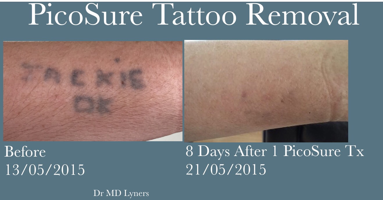 Tattoo removal / fading before cover up with PicoSure