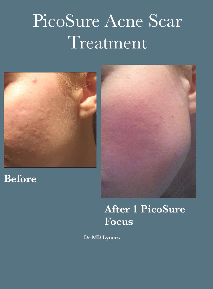 Acne scar treatment with PicoSure Focus Lens Array