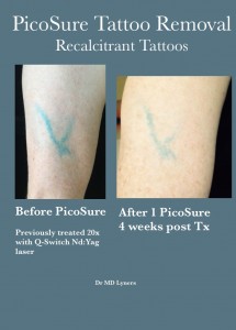 Our price / session is a guide to the cost of our tattoo removal ...