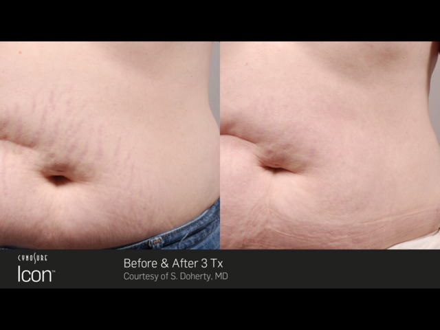 Semipermanent Lip Tint | Empire Beauty Stretch mark removal at UberSkin laser clinic, Derry ...