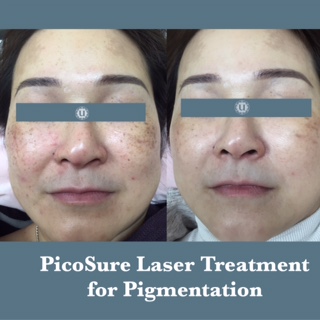 Sun damage and pigmentation treated at UberSkin laser Clinic