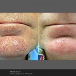 Thread vein removal, spider veins on face, laser clinic Derry