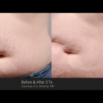 Stretch mark removal at UberSkin laser clinic, Derry, Nothern Ireland
