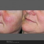 Thread Vein Removal Derry, Northern Ireland, Spider veins, veins on the face, rosacea