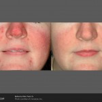 Thread Vein Removal UberSkin, Derry, Northern Ireland, Spider veins, veins on the face, rosacea