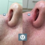 Thread veins treatment Derry, Spider vein removal, thread vein removal, uberskin laser clinic Derry, telangiectasia, spider veins