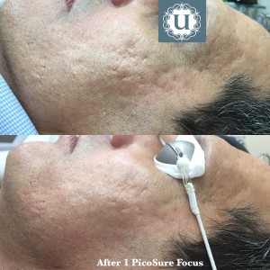 Acne scar treatment Northern Ireland, at UberSkin, Advanced PicoSure Focus Treatment