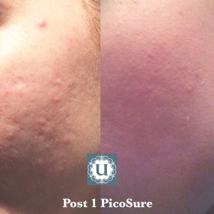 Acne scar treatment at UberSkin, exclusively available at UberSkin, PicoSure Focus