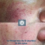 Thread veins Derry, Spider vein removal, thread vein removal, spider veins on the face, laser clinic, Derry, Northern Ireland, rosacea